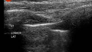 Pneumothorax  ultrasound  Lung Point [upl. by Aicined]