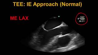 Transesophageal Echocardiography Infective Endocarditis [upl. by Hays]