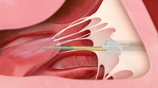 MinimallyInvasive Tendyne TMVR How It Works [upl. by Felic541]