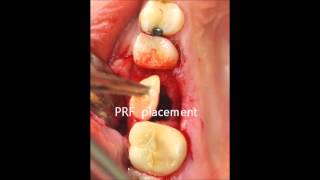 oroantral fistula closure [upl. by Ergener]