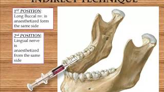 Inferior Alveolar Nerve Block [upl. by Namyh]