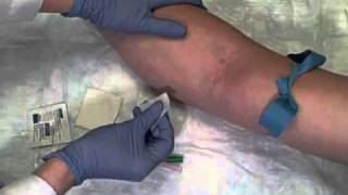 Phlebotomy on Live Patient Straight Needle [upl. by Sucramal]