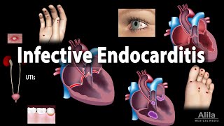 Infective Endocarditis Animation [upl. by Dominica]