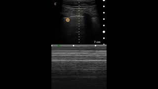 Pneumothorax Ultrasound Image Interpretation [upl. by Rabassa]