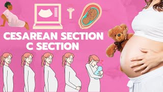 Csection animation  Cesarean section  Baby delivery animation [upl. by Benyamin419]