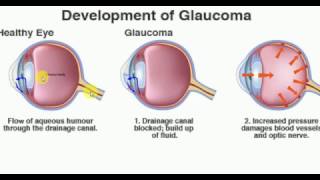 OPTHALMOLOGY GLAUCOMA PART 1 BASICS Drainage of aqueous humour [upl. by Netnilc]