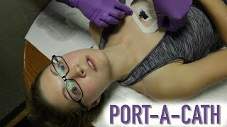 HOW TO ACCESS A PORTACATH IMPLANTED PORT [upl. by Braca]