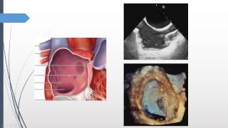 HIGHLIFE TransSeptal Mitral Valve Replacement TSMVR  step by step  EuroPCR 2021 [upl. by Nairim]