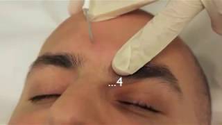 Sebaceous Hyperplasia Treatment using Electrodessication [upl. by Jamilla]