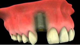 Implant versus Dental Bridge  Which Is More Reliable [upl. by Attenal]