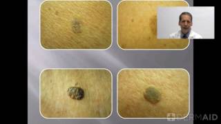 Seborrheic Keratoses [upl. by Aihppa]