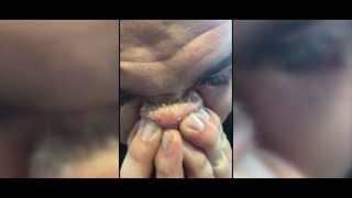 DIY Blackhead Removal Goes Viral [upl. by Acsirp]