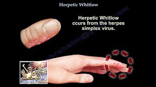 Herpetic Whitlow  Everything You Need To Know  Dr Nabil Ebraheim [upl. by Gerdi]