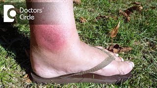 How to manage spider bite with swelling amp redness  Dr Nischal K [upl. by Ellord39]