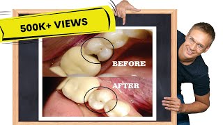 Class II cavity restoration  STEPBYSTEP [upl. by Utham231]