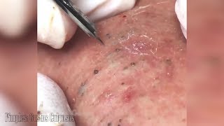 Extracción de PUNTOS NEGROS te dejara con ganas de ver mas  Blackhead [upl. by Nylssej]