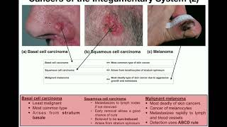 Anatomy  The Three Types of Skin Cancers [upl. by Assej]