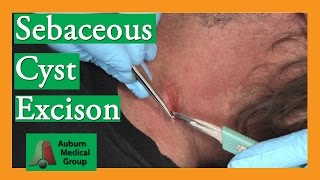 Sebaceous Cyst Removal  Auburn Medical Group [upl. by Portugal]