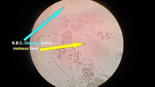 Acute Diarrhea  Approach to Causes Enterotoxic vs Invasive Watery vs Bloody Diarrhea [upl. by Alyakcm]