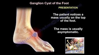 Foot and Ankle ganglion cyst  Everything You Need To Know  Dr Nabil Ebraheim [upl. by Oniuqa401]