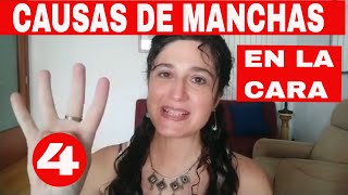 4 CAUSAS DE MANCHAS EN LA CARA 😳 ¿A QUIÉNES SALEN ¿CÓMO DIFERENCIARLAS [upl. by Norvall]