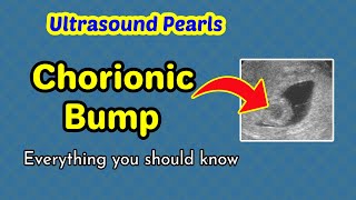 Ultrasound Pearls Chorionic Bump [upl. by Nosreve186]