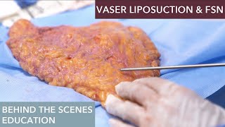 The Science Behind Vaser Liposuction How Does It Work [upl. by Eizeerb]