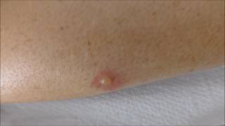 blisters from mosquito bites  before and after treatment [upl. by Aremat]