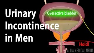 Urinary Incontinence in Men Animation [upl. by Nydia]