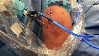 MAKOplasty RoboticAssisted Surgery for Partial Knee Replacement [upl. by Guarino]