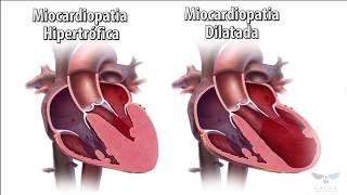 Miocardiopatia em 1 Minuto [upl. by Lellih]