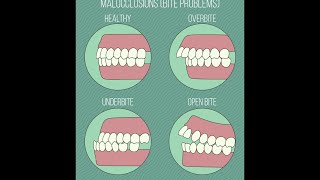 Different Types of Malocclusions [upl. by Faythe]