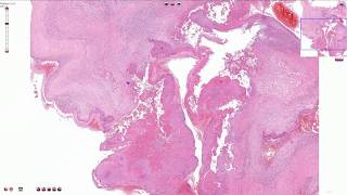 Infective Endocarditis  Histopathology [upl. by Epstein]