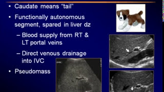 Cavernous hemangioma  Pathology Usmle step 1 [upl. by Xilef958]