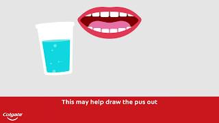 How To Treat a Gum or Tooth Abscess  Colgate® [upl. by Cirdec518]