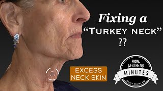 72 yo quotTurkey Neckquot Lift  ReTightening the Neck  Aesthetic Minutes Necklift [upl. by Aigneis]