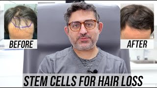 STEM CELL Hair Restoration 4 month Update [upl. by Haveman]