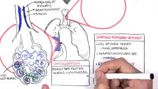 PART I  Pneumonia Overview Lobar and Bronchopneumonia [upl. by Tri470]