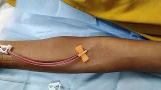 First time Cannulation of AV Fistula [upl. by Nailluj]