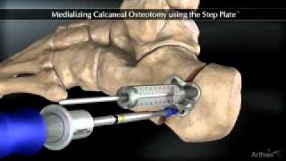 Medializing Calcaneal Osteotomy [upl. by Glad]