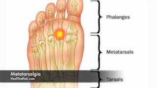 Metatarsalgia Foot Pain Causes Symptoms amp Treatments [upl. by Glorianna]