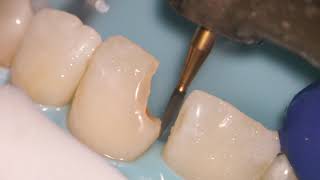 Teeth Bonding  Front tooth filling EXPLAINED [upl. by Nyleaj]