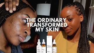 The Ordinary Skin Transformation Mandelic Acid Cleared My Acne  xoreni [upl. by Yovonnda421]