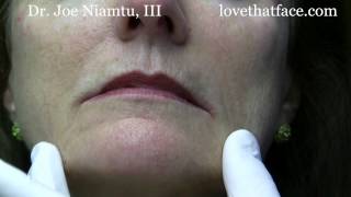 Botox Injection to DAO corner of mouth by Dr Joe Niamtu III [upl. by Kelsi]