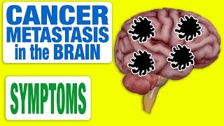 Cancer Metastasis in the Brain  All Symptoms [upl. by Grania]