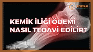 KEMİK İLİĞİ ÖDEMİ NASIL TEDAVİ EDİLİR [upl. by Ennaitsirhc]