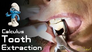 Calculus Tooth Extraction [upl. by Past302]