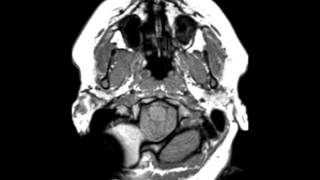 Chiari II Malformation [upl. by Enotna]