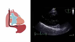 Mastering important TEE views transesophageal echocardiography [upl. by Aymer220]