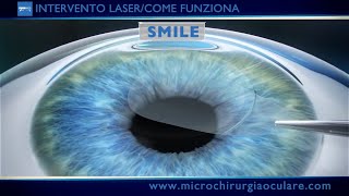 Intervento Laser Occhi Come Funziona [upl. by Nylitsirk]